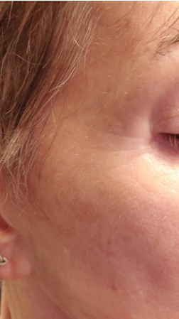 After — Before and after using YEOUTH Retinol Serum — visible improvement in skin texture