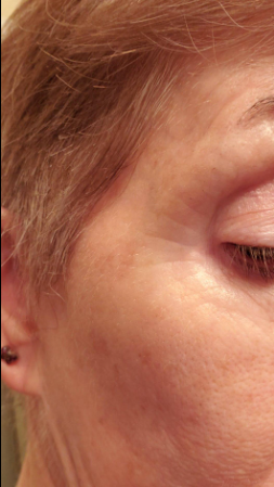 Before — Before and after using YEOUTH Retinol Serum — visible improvement in skin texture