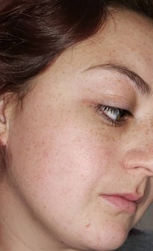 After — Skin transformation — before and after YEOUTH Retinol treatment