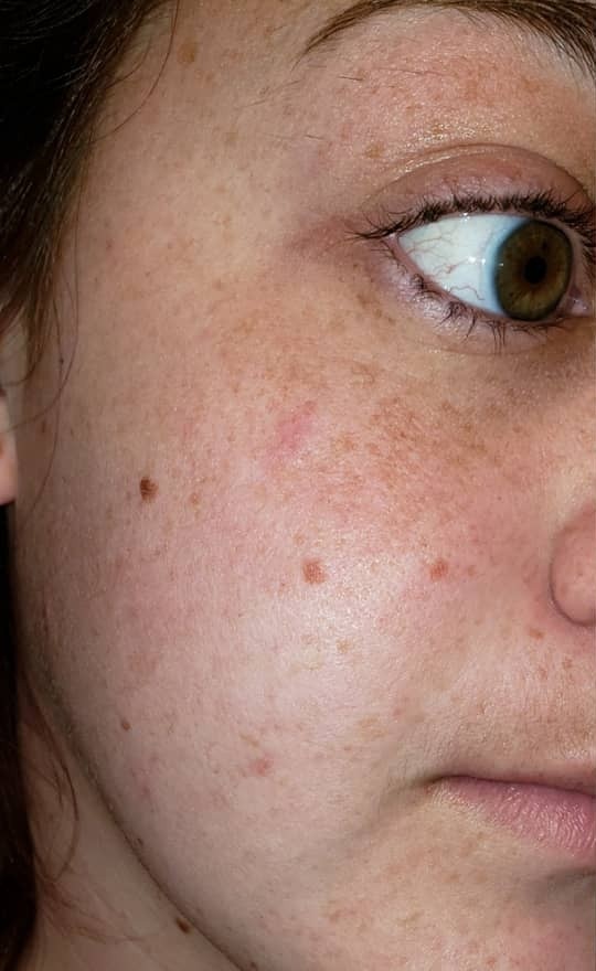 Before — Skin transformation — before and after YEOUTH Retinol treatment