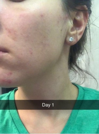 Before — Customer results — smoother, brighter skin after YEOUTH Retinol routine